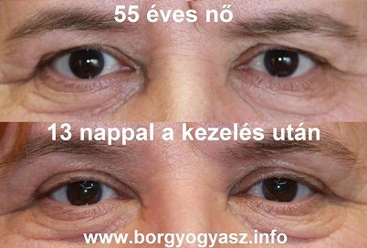 csüngő szemhéj műtét)
